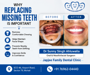 Before and after dental implant treatment showing real patient results by Dr. Sunny Singh Ahluwalia at Japjee Family Dental Clinic, Mohali.